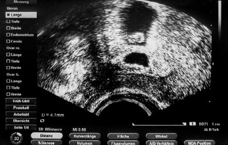 Das erste Ultraschall